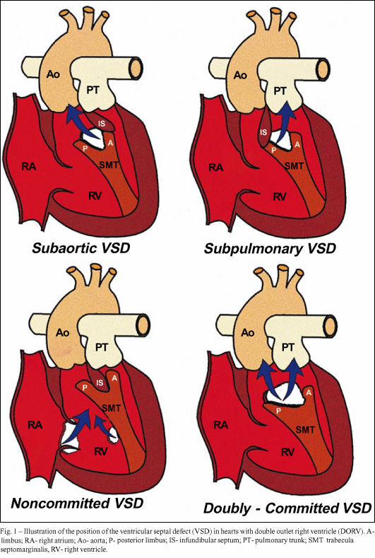 Double outlet right ventricle with anterior and left-sided aorta and subpulmonary ventricular septal defect