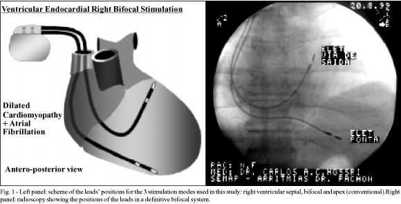 Right ventricular bifocal stimulation in the treatment of dilated cardiomyopathy with heart failure