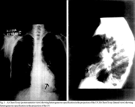 Endomyocardial fibrosis associated with massive calcification of the left ventricle