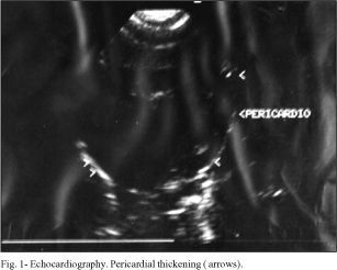 Constrictive pericarditis in a 19-month-old child
