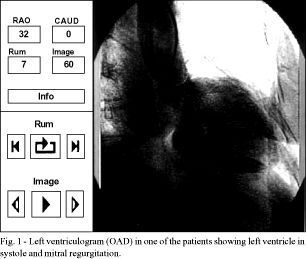 A new surgical approach for treating dilated cardiomyopathy with mitral regurgitation