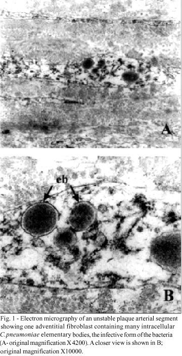 Great amount of C.pneumoniae in ruptured plaque vessel segments at autopsy. A comparative study with stable plaques