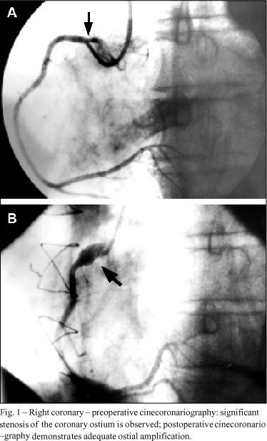 Coronary bilateral ostial enlargement using the saphenous vein in a patient with syphilitic aortitis
