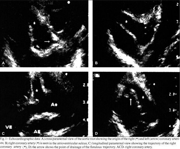Right coronary artery fistula with congestive heart failure in the neonate. Doppler echocardiographic diagnosis and closure with detachable balloon