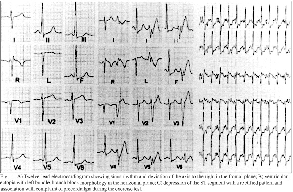 Isolated noncompaction of the myocardium
