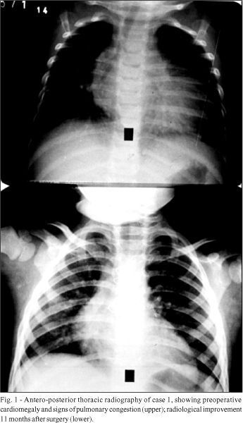 Congenital atresia of the ostium of the left coronary artery. Diagnostic difficulty and successful surgical revascularization in two patients