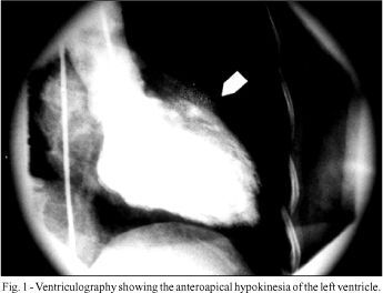 Myocardial infarction and subsequent pregnancy