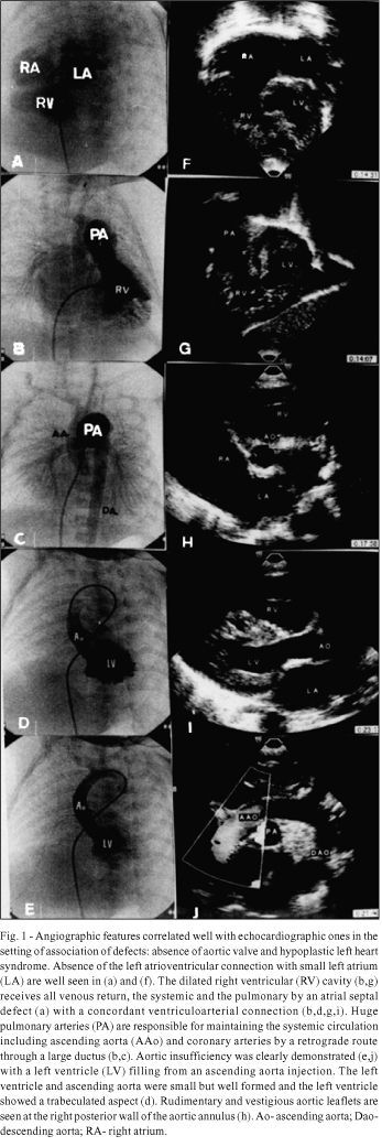 Absence of the aortic valve associated with hypoplastic left-sided heart syndrome