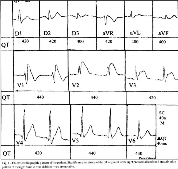 The Brugada syndrome. Outcome of one case
