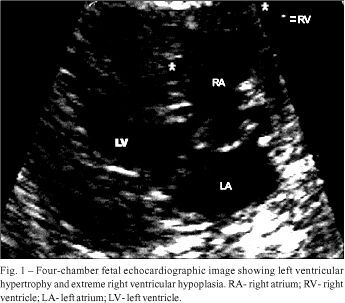 Association of pulmonary atresia with intact ventricular septum and aortic valve stenosis. Prenatal diagnosis