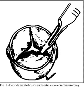 Reconstructive surgery for aortic valve disease