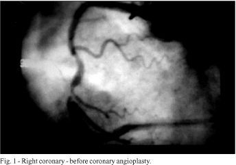 Use of tandem stents for treatment of helicoidal dissection of the right coronary artery