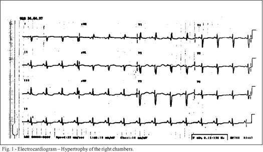 Right-sided heart failure in a 37-year-old man with systemic lupus erythematosus