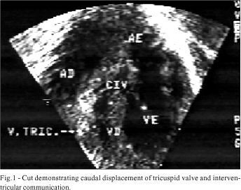 Ebstein's anomaly with imperforate tricuspid valve. Prenatal diagnosis