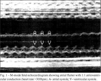 Fetal tachyarrhythmia with 1:1 atrioventricular conduction. Adenosine infusion in the umbilical vein as a diagnostic test