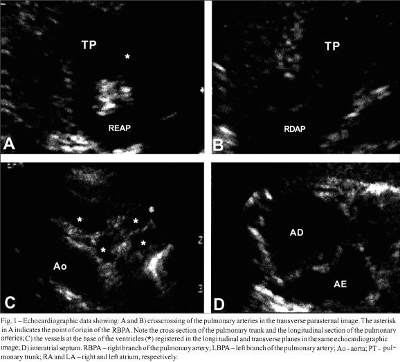 Multiple arterial anomalies in the newborn infant. Echocardiographic and angiographic diagnosis