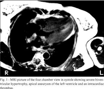 Apical aneurysm and left ventricular hypertrophy