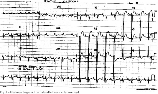 Heart failure in a 9-year-old child after treatment with anthracycline for Wilms' tumor