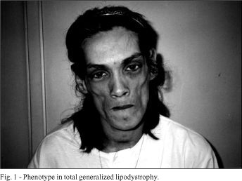 Cardiac involvement in total generalized lipodystrophy (Berardinelli- Seip syndrome)