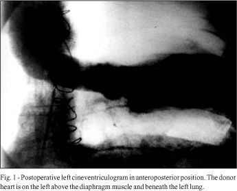 Heart transplant in a patient with complete absence of the pericardium