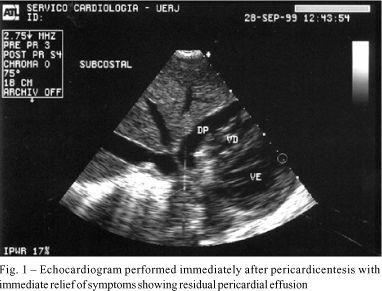 Cardiac tamponade in systemic lupus erythematosus. Report of four cases
