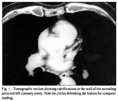 Detection of coronary artery disease based on the calcification index obtained by helical computed tomography