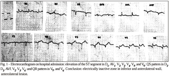 Pseudo-myocardial infarction during an episode of herpes zoster