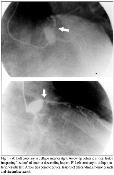 Aneurysm of the left main coronary artery