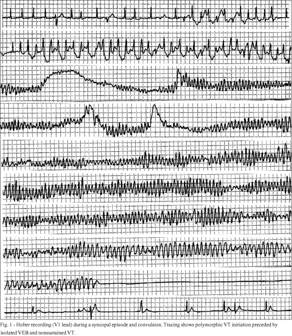 Catecholaminergic polymorphic ventricular tachycardia. An important diagnosis in children with syncope and normal heart
