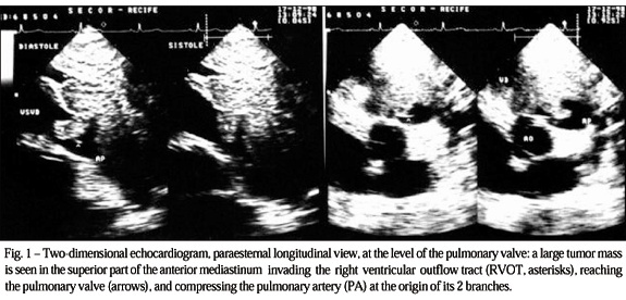 Cardiac extension of primary mediastinal seminoma compressing the right ventricular outflow tract