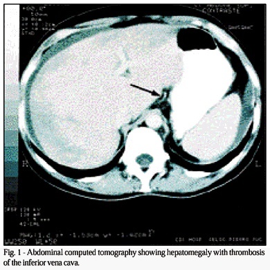 A 54-year-old male with chronic myeloproliferative disorder and pulmonary thrombotic arteriopathy