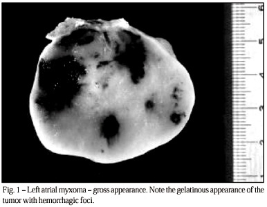 Primary neoplasms of the heart. Clinical and histological presentation of 50 cases