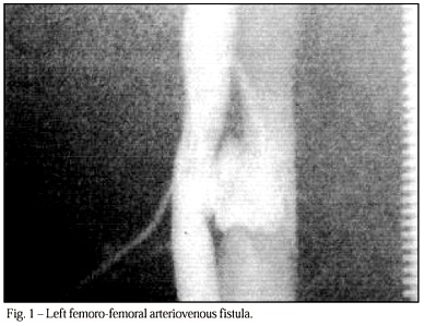 Remission of heart failure through endoluminal repair of femoral arteriovenous fistula with the use of a covered stent