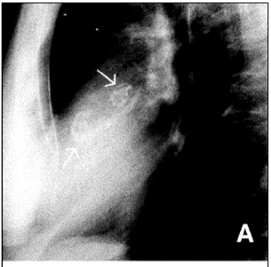 Calcified aneurysms in coronary arteries of a 48-year-old patient