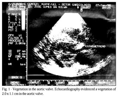 Pneumococcal endocarditis of subacute evolution