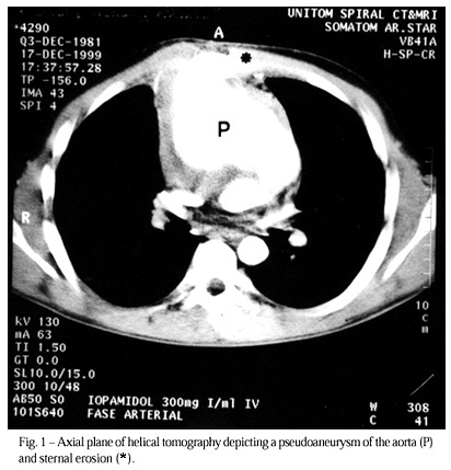 Surgical repair of a pseudoaneurysm of the ascending aorta after aortic valve replacement