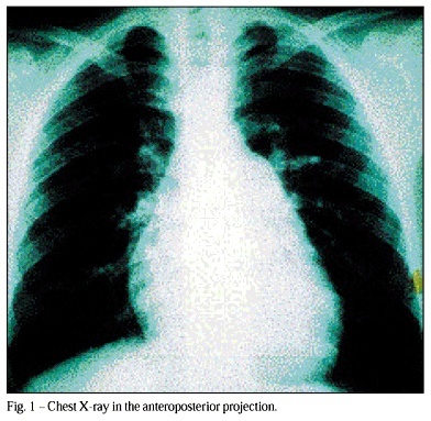 An 18-year-old male with dyspnea and pulmonary arterial hypertension