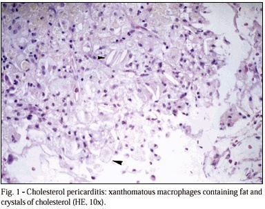 Cholesterol pericarditis. A specific but rare cause of pericardial disease