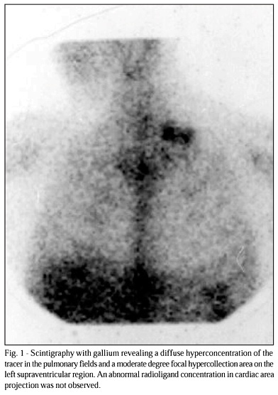 Histoplasmosis as a late infectious complication following heart transplantation in a patient with Chagas' disease