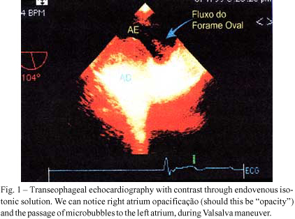 Clinical impact of transesophageal echocardiography in patients with stroke without clinical evidence of cardiovascular sources of emboli