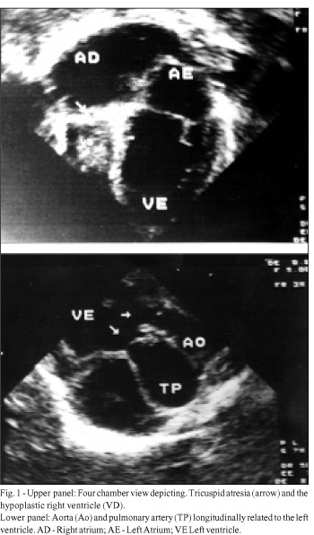 Double-outlet left ventricle. Echocardiographic diagnosis