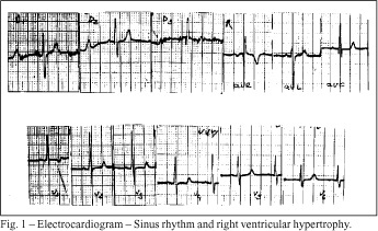 Twenty-year-old woman with pulmonary hypertension, syncope, and severe headache