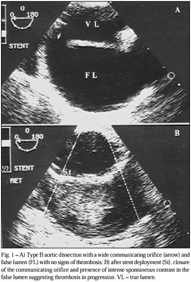 Use of transesophageal echocardiography during implantation of aortic endoprosthesis (stent). Initial experience