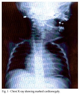 Uhl's anomaly. Differential diagnosis and indication for cardiac transplantation in an infant