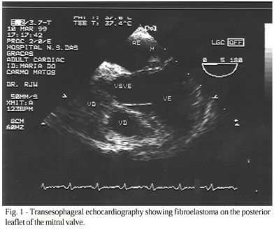 Fibroelastoma of the mitral valve as a cause of transient ischemic stroke
