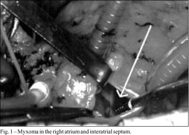Multiple recurrences of cardiac myxomas with acute tumoral pulmonary embolism