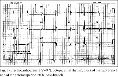 A sixty-four-year-old woman with Chagas' disease, who underwent implantation of a permanent cardiac pacemaker and evolved with rapidly progressive heart failure