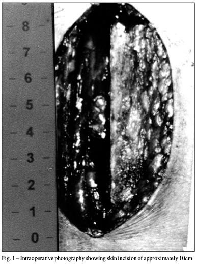 Mini-sternotomy for the treatment of aortic valve lesions