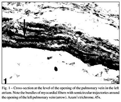 Morphofunctional study of the junction between the left atrium and the pulmonary veins in patient with pulmonary hypertension