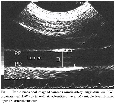Arterial distensibility as a possible compensatory mechanism in chronic aortic regurgitation